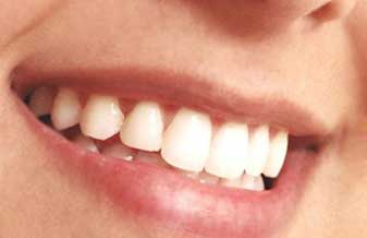 Implantes Osseointegrados Reabilitacao & Estetica Oral - Foto 1